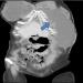 Figure 3: Coronal view of a CT scan. Blue arrow demonstrating the abscess collection tracking downwards from the chest wall to the left lumbar region